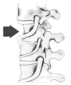 subluxation